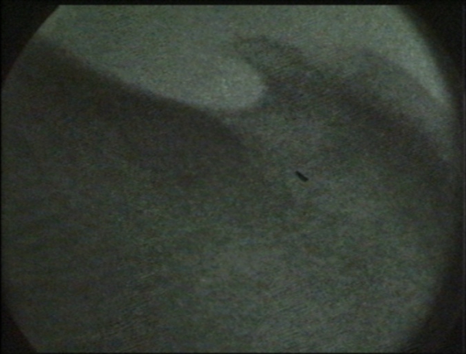 Fluoroscopic image of the heel spur