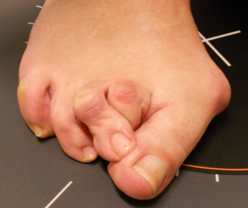 Hallux Valgus (bunion) and hammertoes : before