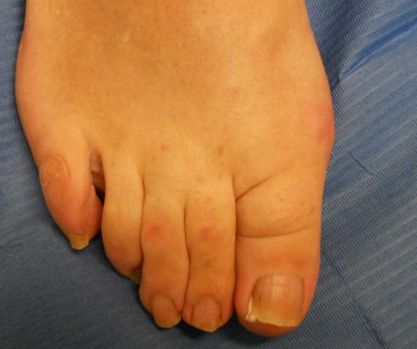 Hallux Valgus (bunion) and hammertoes : after