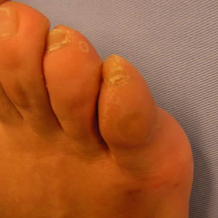 Dorsal callus (exostosis) in the fifth toe