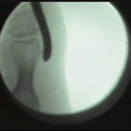 Fluoroscopic image of the fifth toe’s exostosis