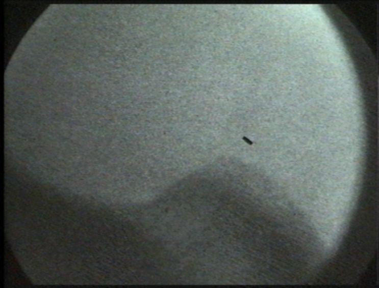 Imagen fluoroscópica de la eliminación de la exóstosis calcánea (espolón) por cirugía M.I.S